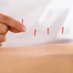 Why Is Dry Needling Illegal?
